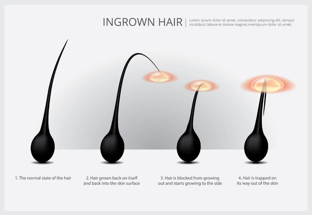 ingrown hair, ingrown hair treatment, hair